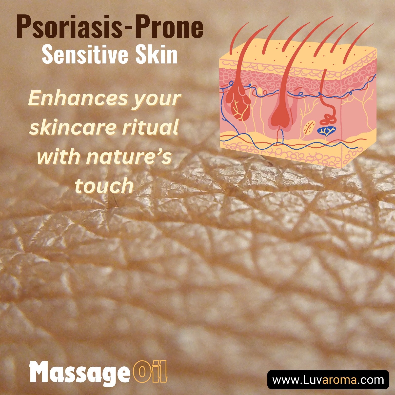 Psoriasis Relief
